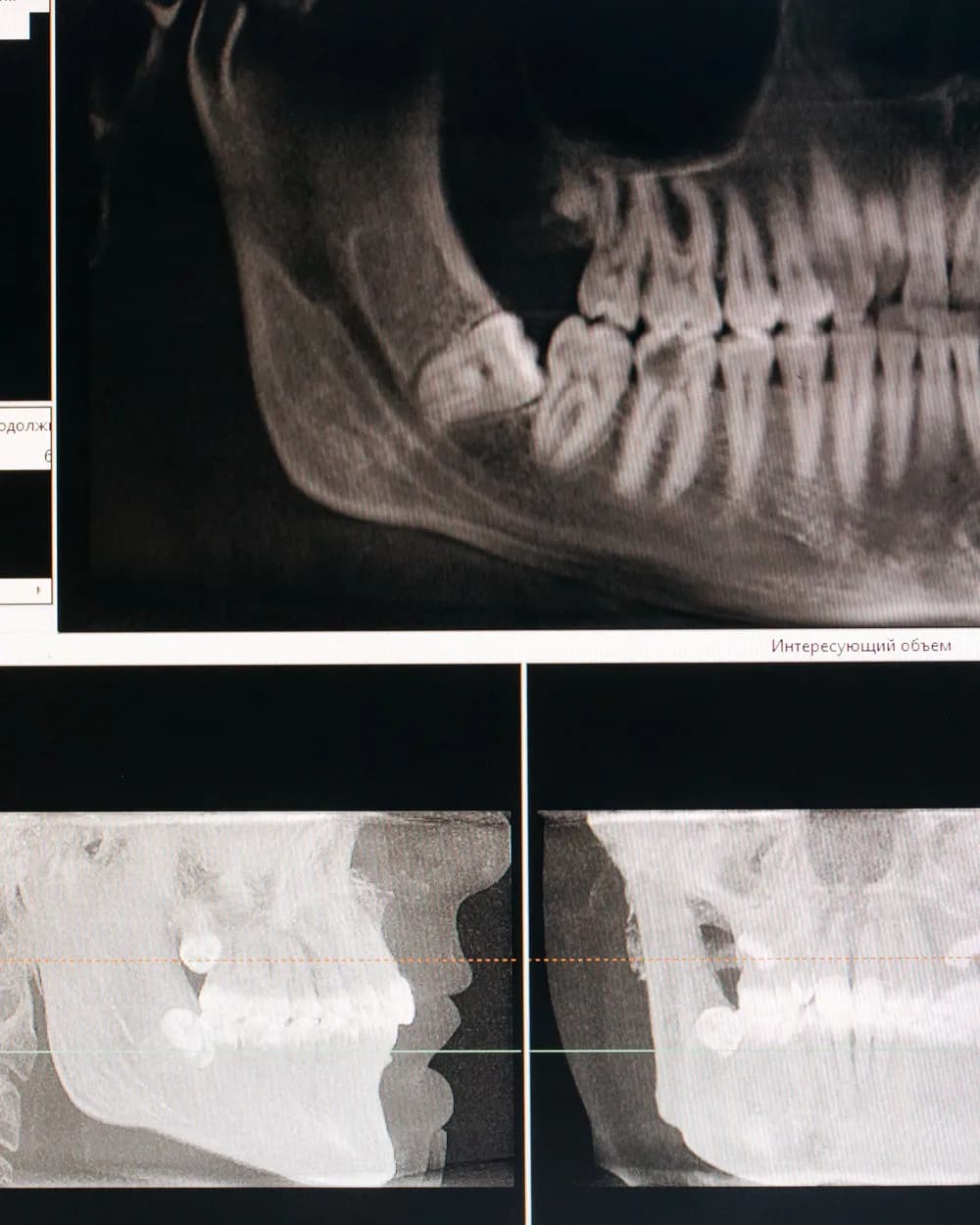 Radiografía panorámica dental en pantalla
